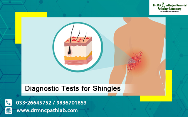Diagnostic Tests for Shingles