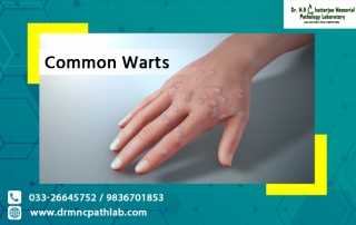 Common Warts